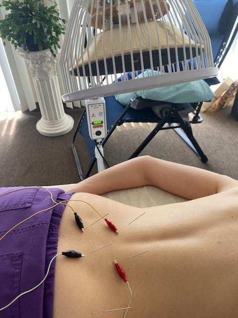 Acupuncture back