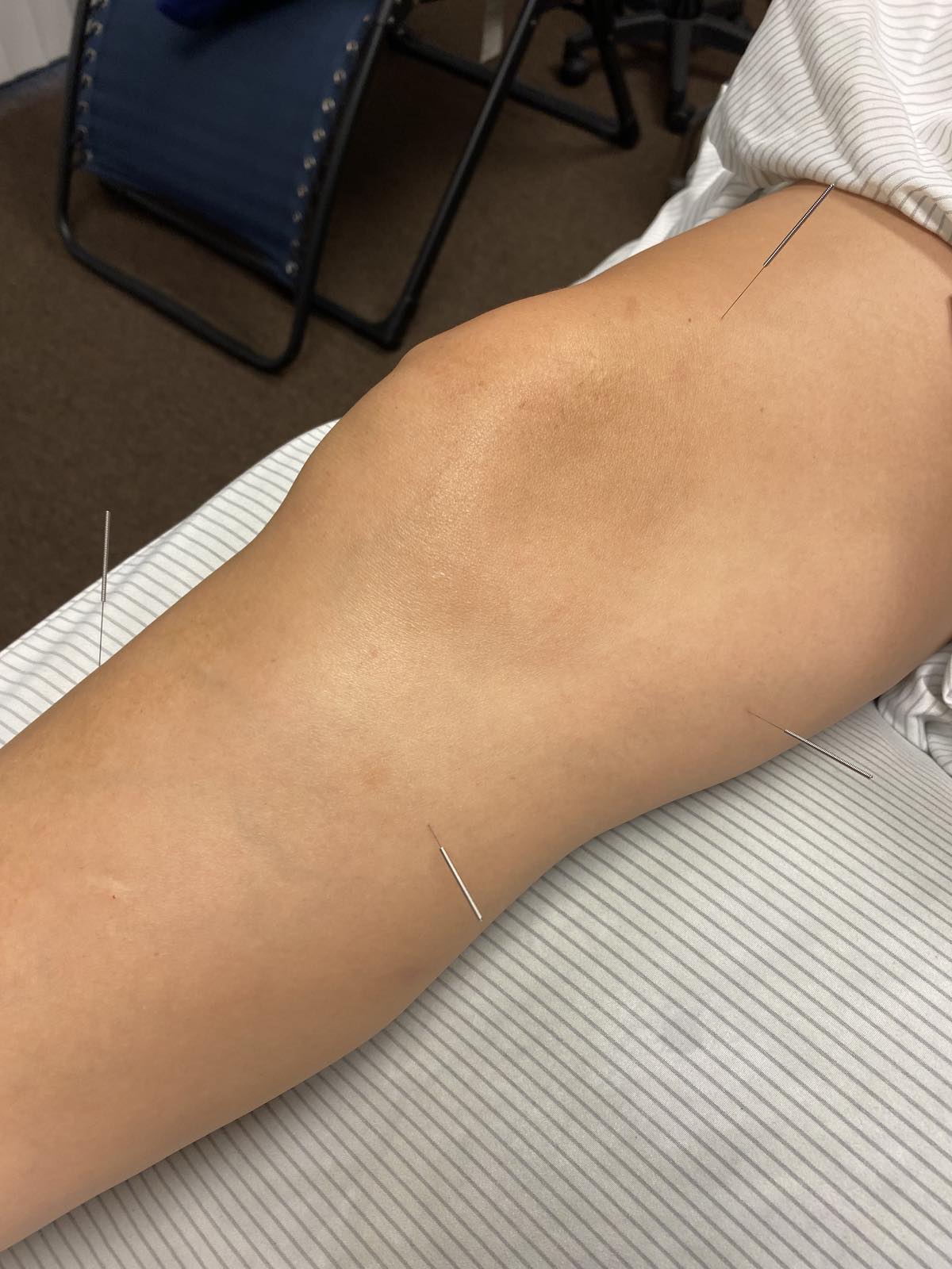 Acupuncture legs two