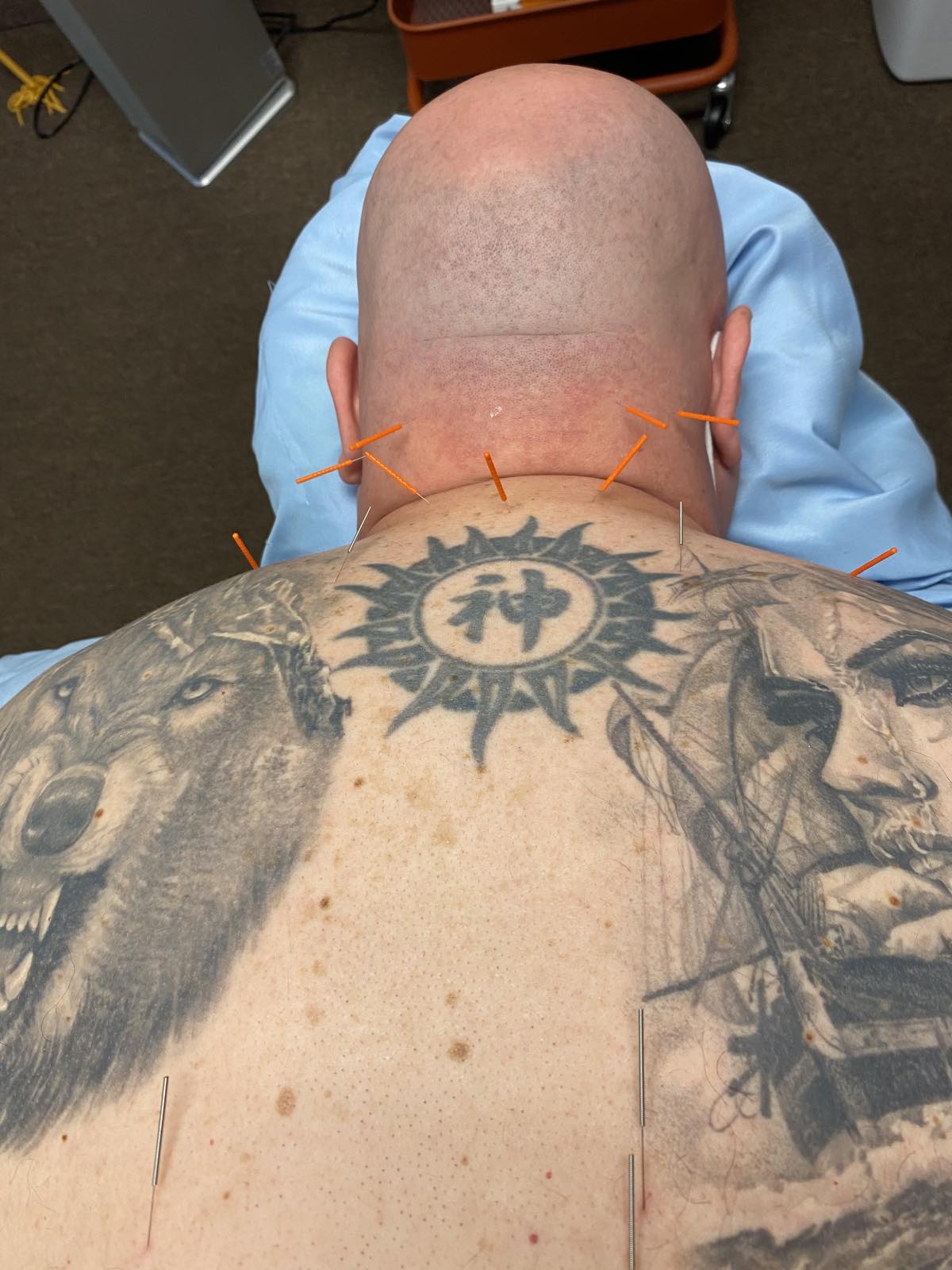 Acupuncture neck two