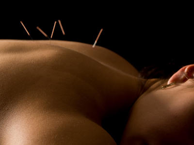 Acupuncture