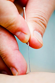 Acupuncture FAQS