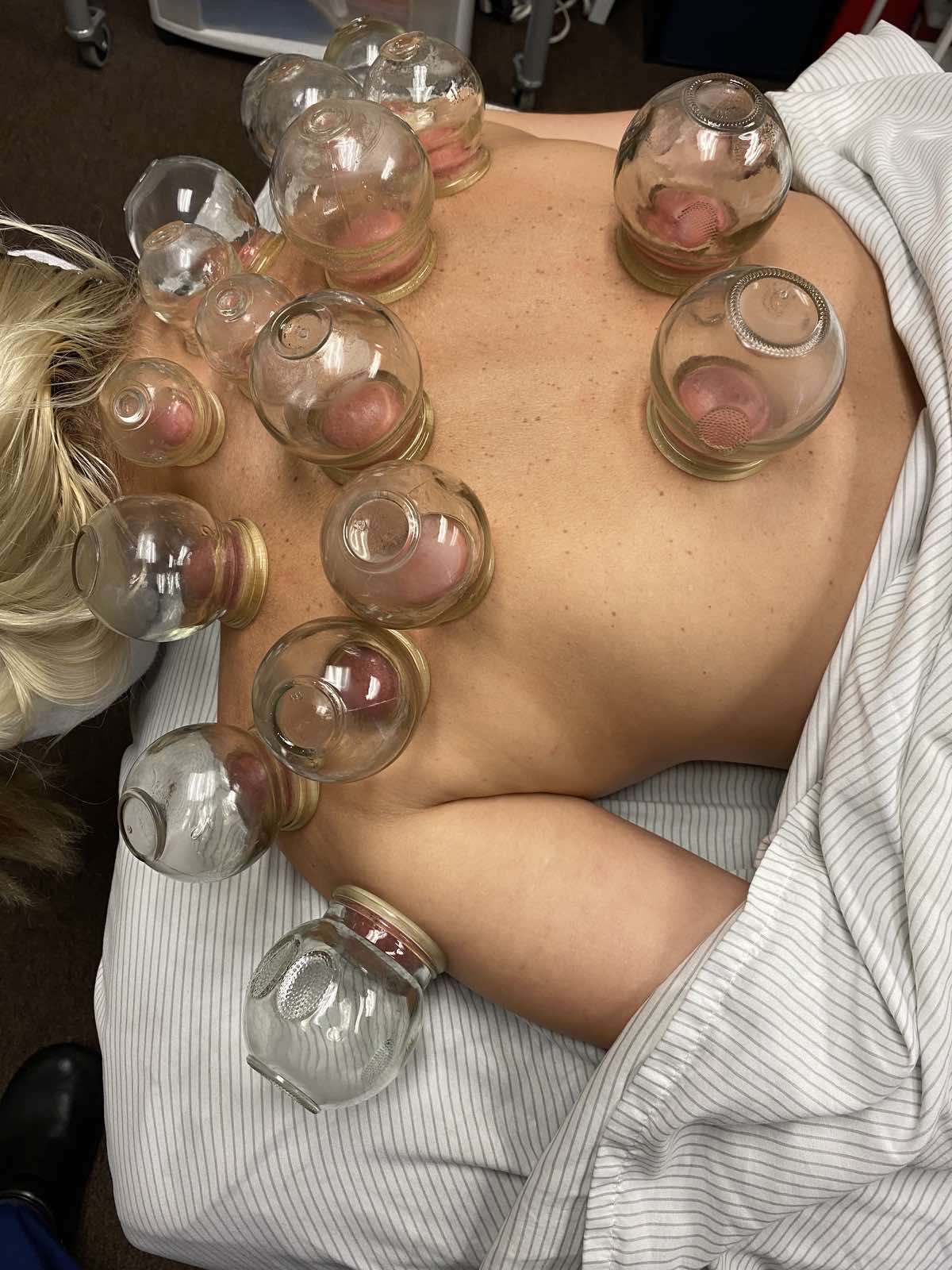 Cupping back