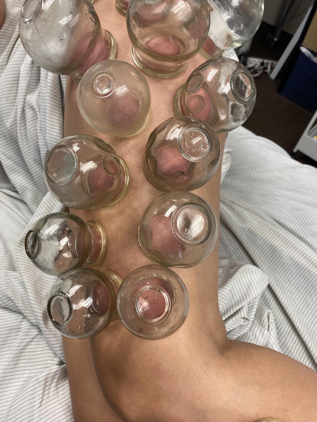 Cupping legs four