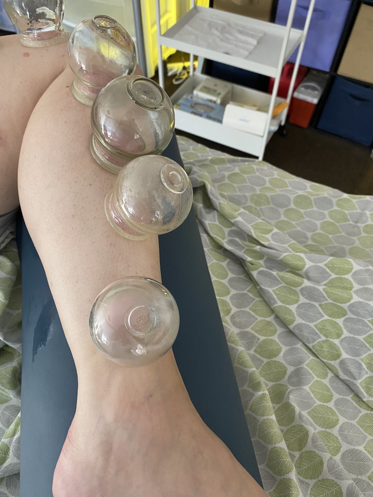 Cupping legs seven