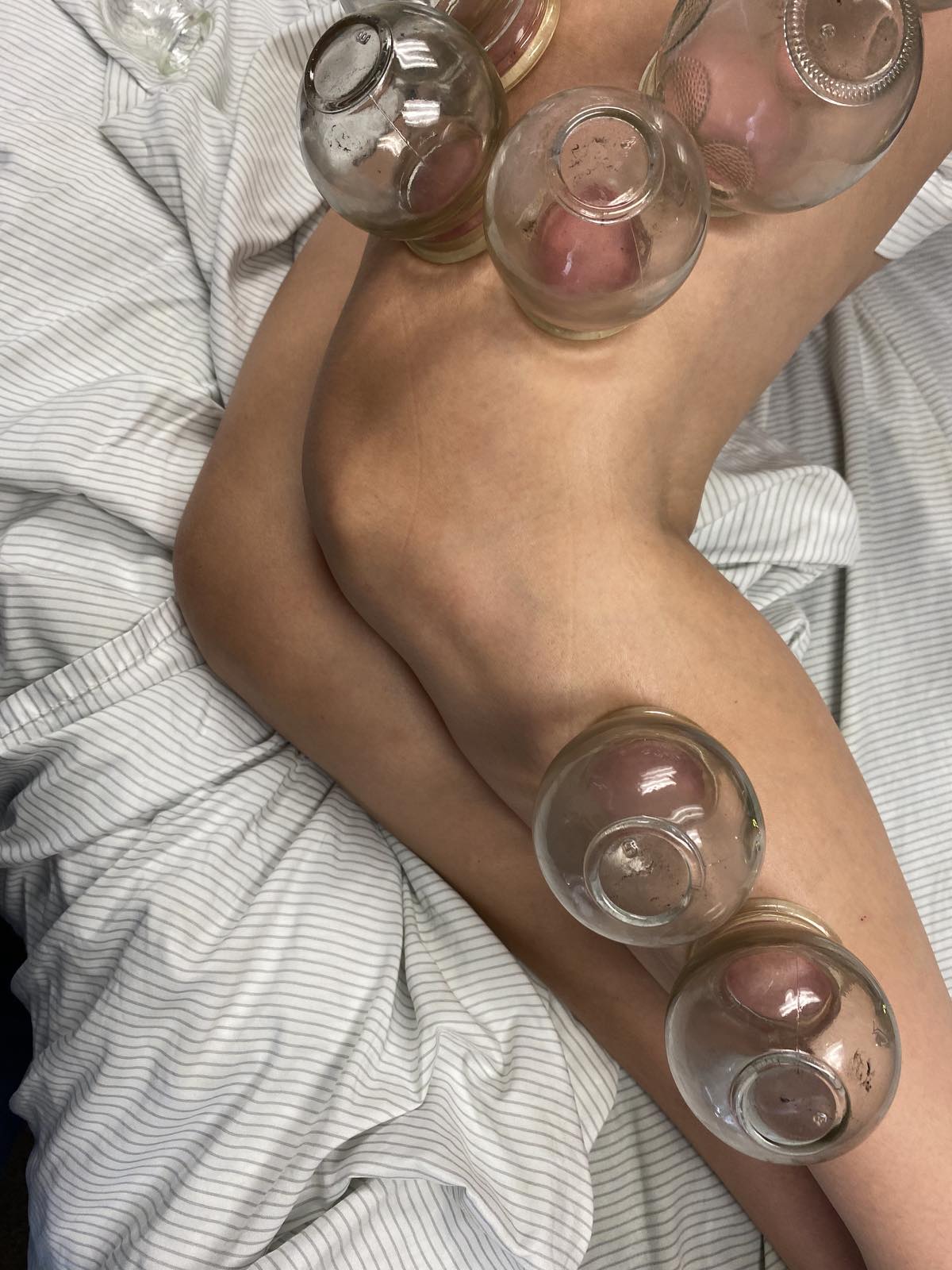 Cupping legs two