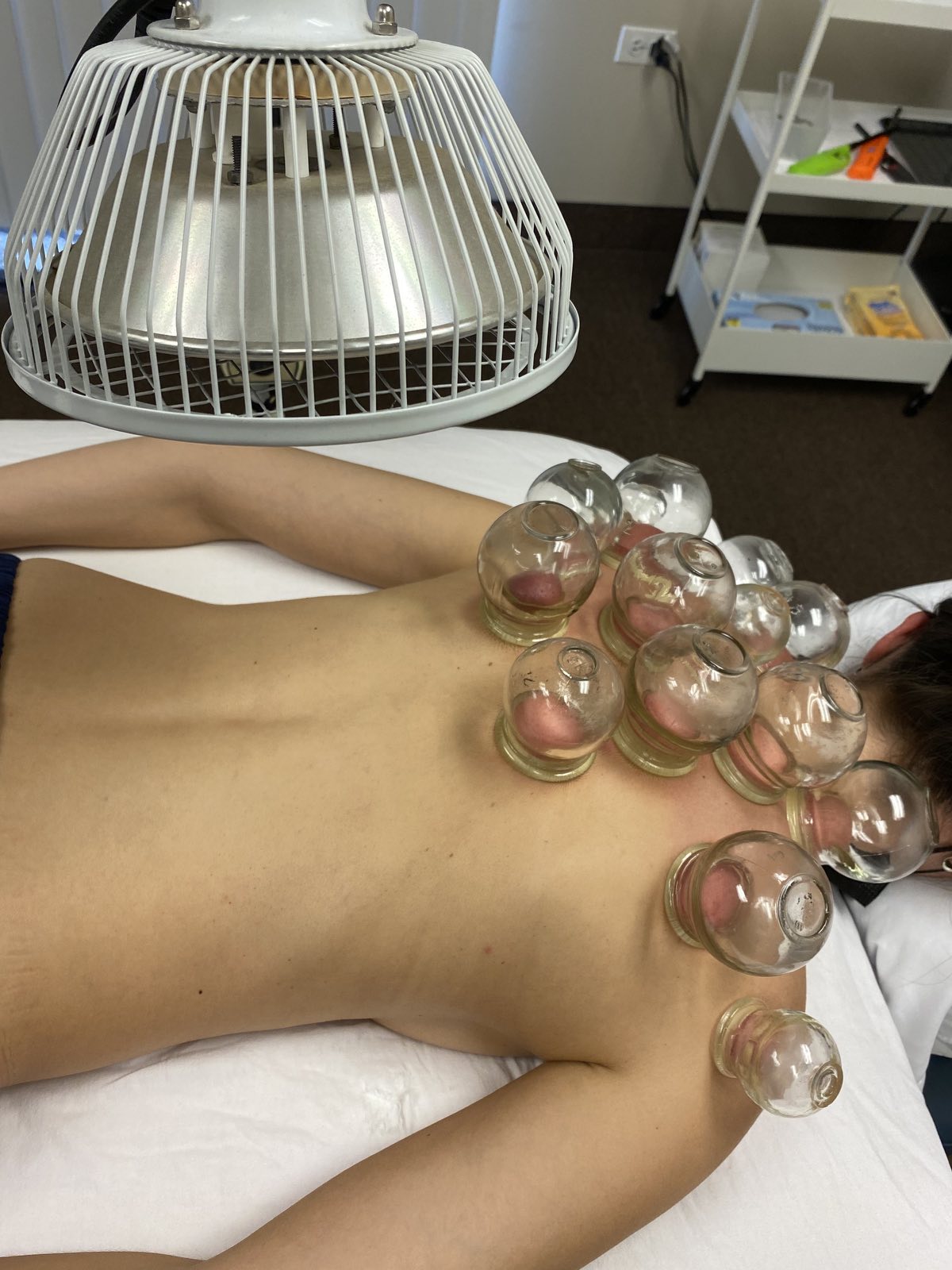 Cupping three