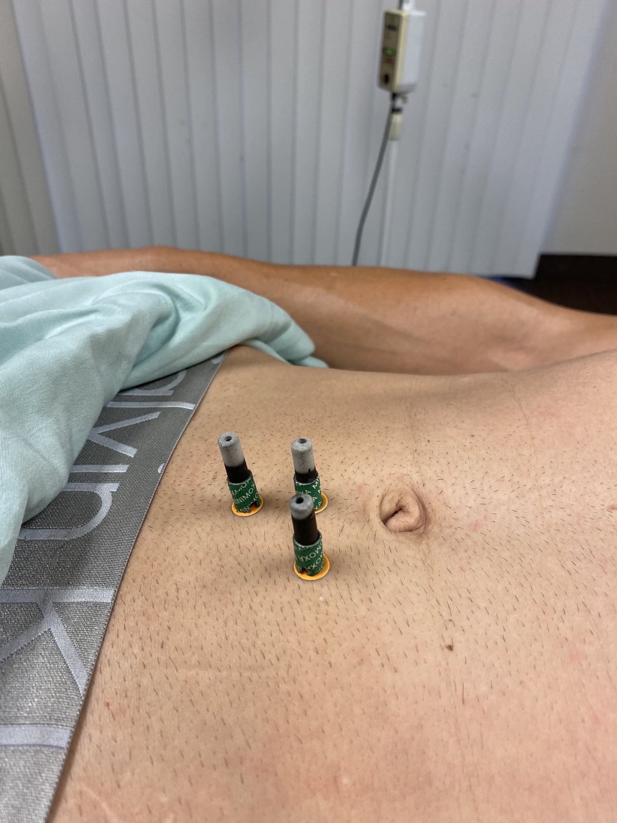 Moxibustion belly